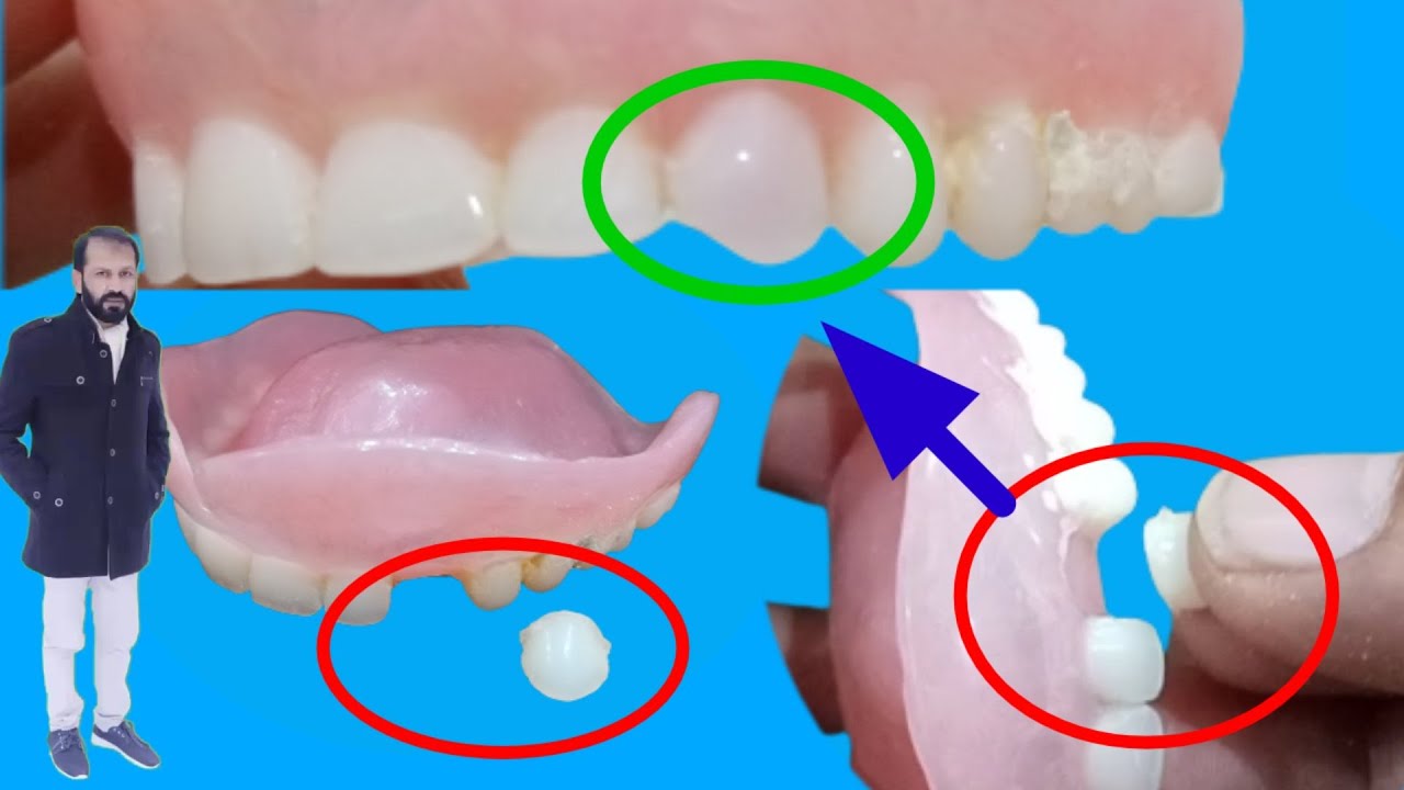 How to repair a broken denture tooth || How to fix a broken denture tooth at home||Tooth repair....