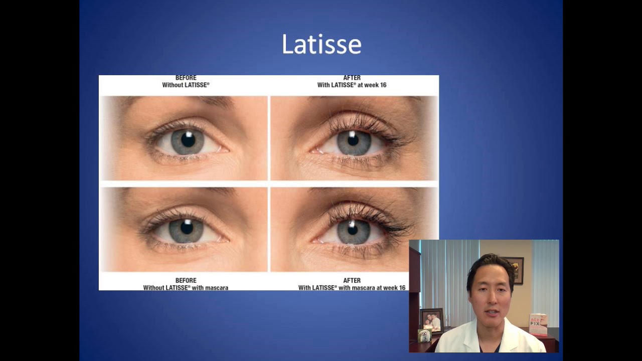 How Can I Make My Eyelashes Thicker and Longer - Latisse Consultation - Dr. Anthony Youn