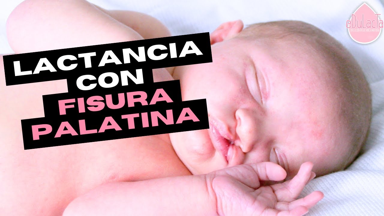 Lactancia en bebés con fisura palatina: guía práctica