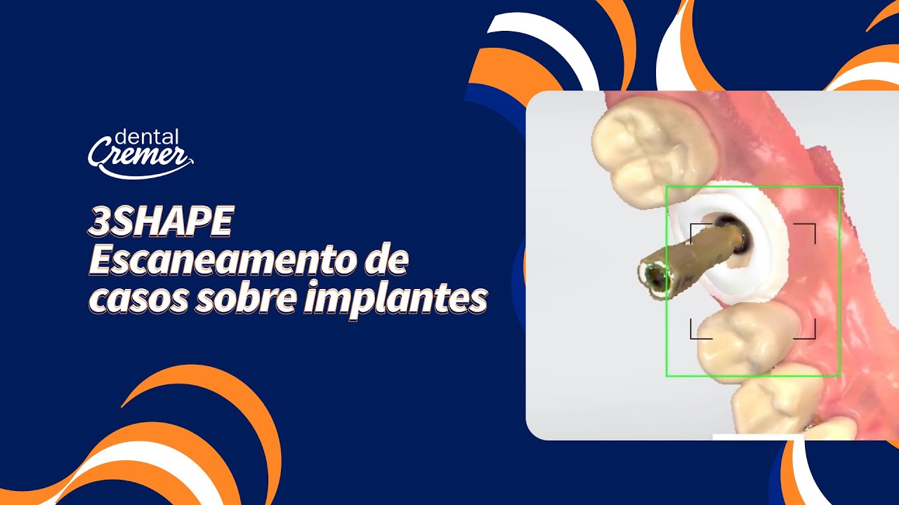 Escaneamento de Casos sobre Implantes com 3Shape | Fluxo Digital Simplificado