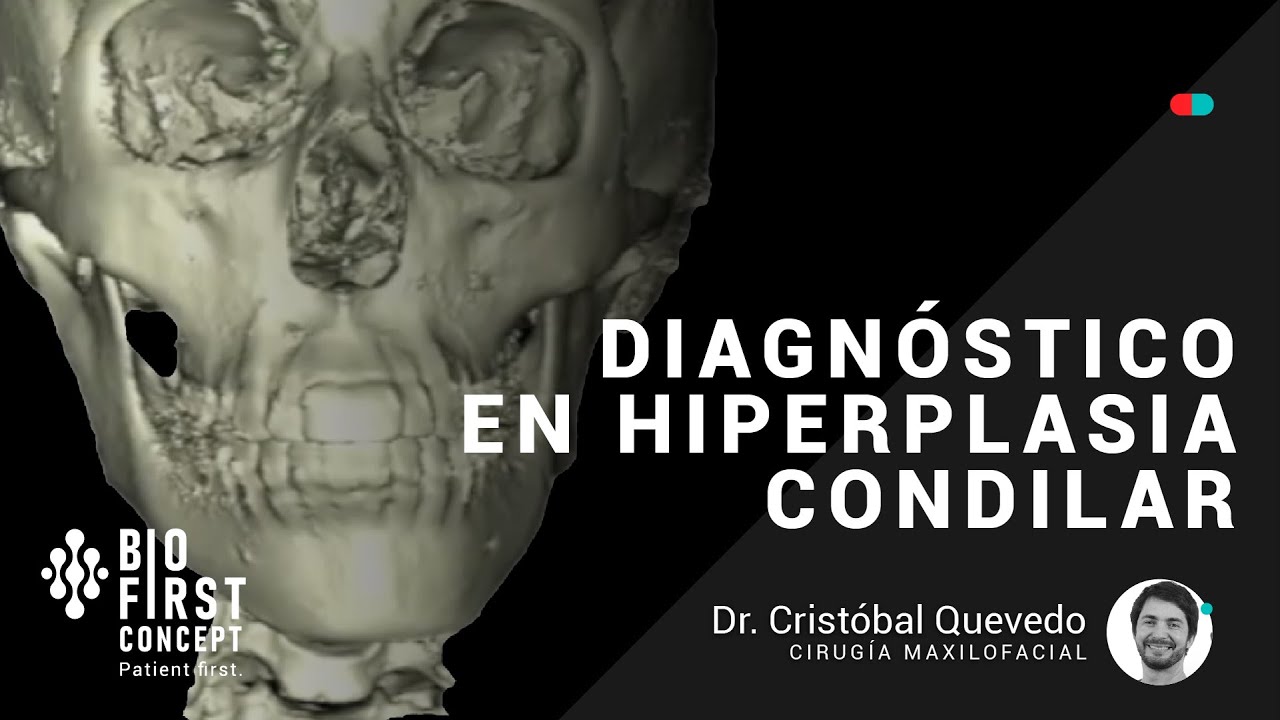 Diagnóstico en Hiperplasia Condilar Mandibular  [ATM Series 13]