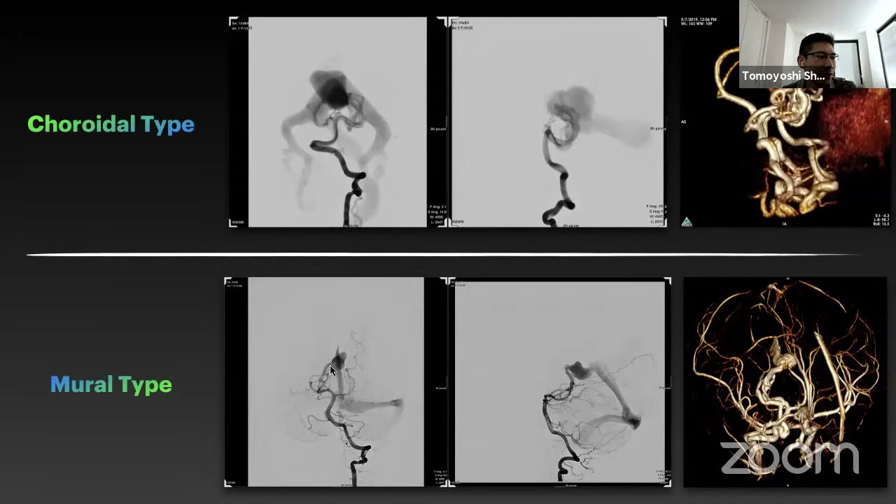 Entrance to the Vein of Galen Aneurysmal Malformation with Tomoyoshi Shigematsu, MD, PhD