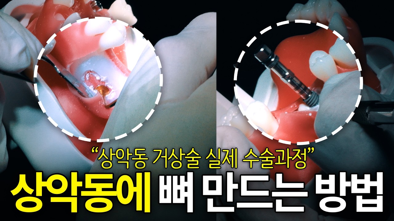 상악동 뼈이식 임플란트 과정 직접 보여드립니다