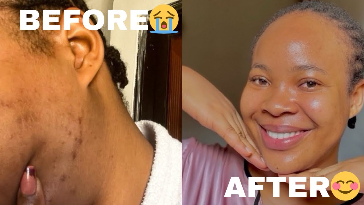 HOW TO GET RID OF DARK SPOTS / HOW I GOT RID OF MY ACNE SCARS USING NUTRITION AND ACWELL TONER