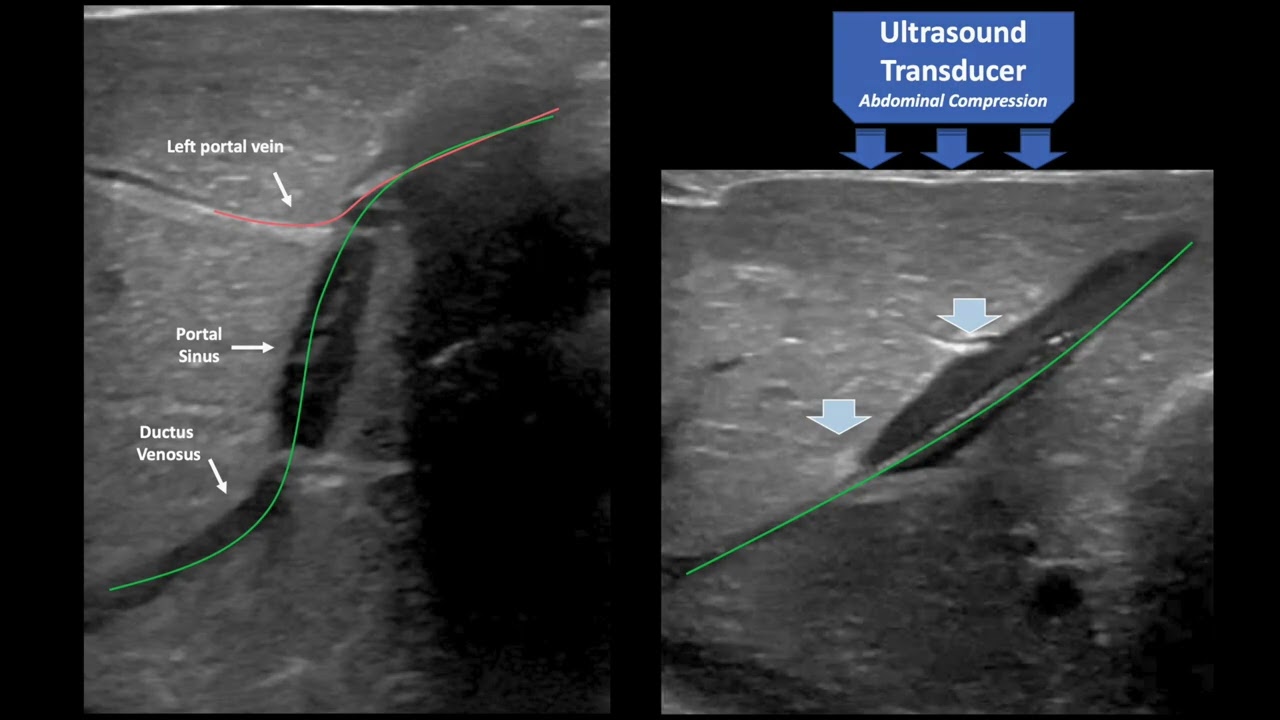 Ultrasound-guided UVC 3_Alignment of Vessels and Cannulation of the Ductus Venosus (Kozyak et al)