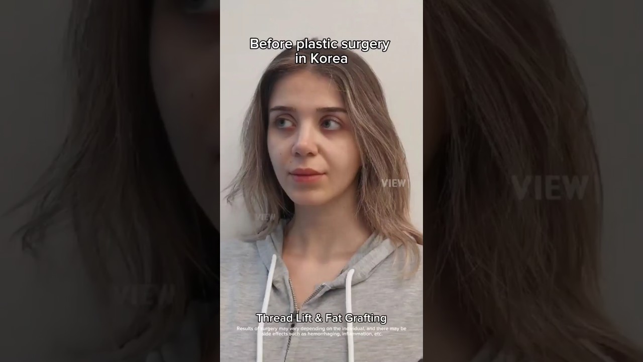 Thread lift & fat grafting in Korea #plasticsurgery #korea #viewplasticsurgery #seoul #fyp #vlog
