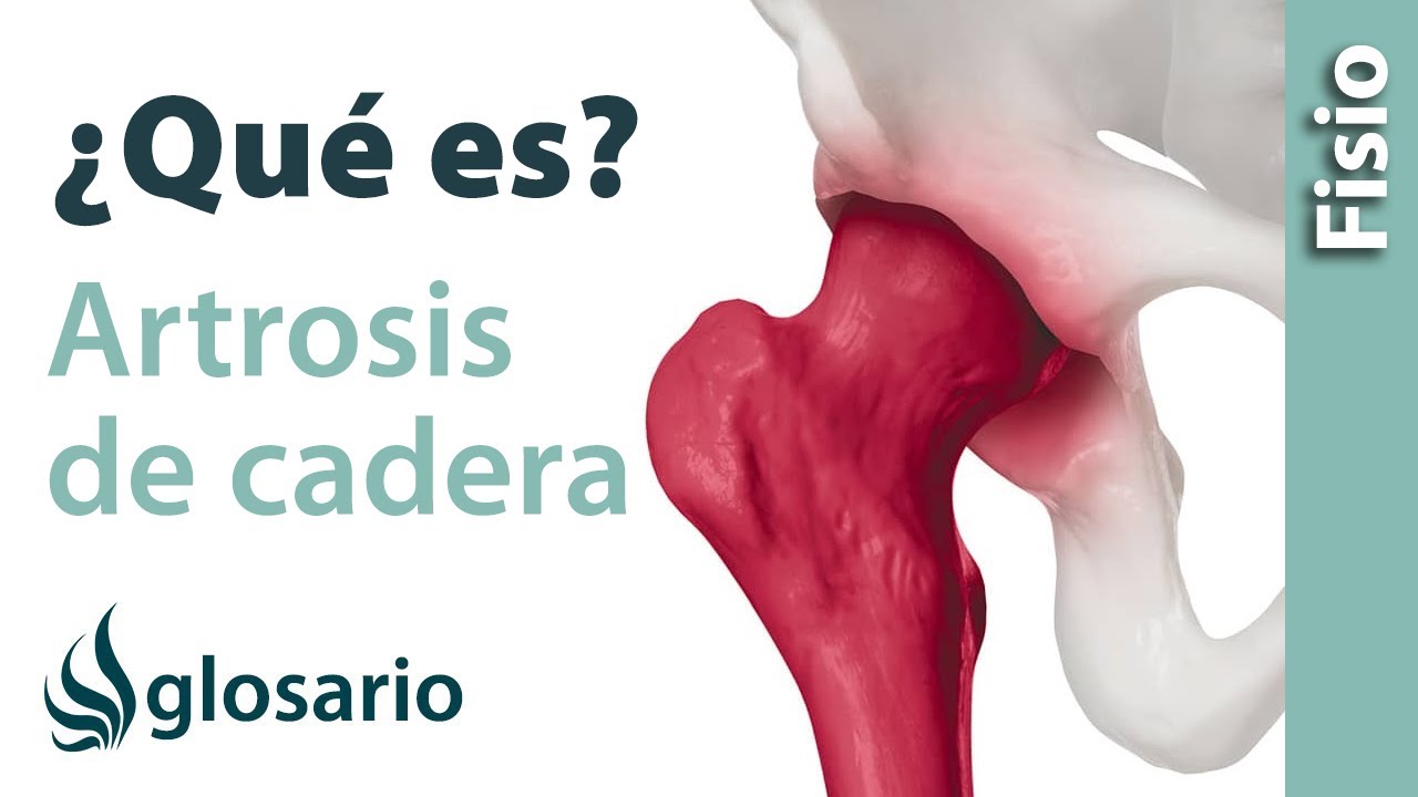 ARTROSIS DE CADERA | &iquest;Qu&eacute; es?