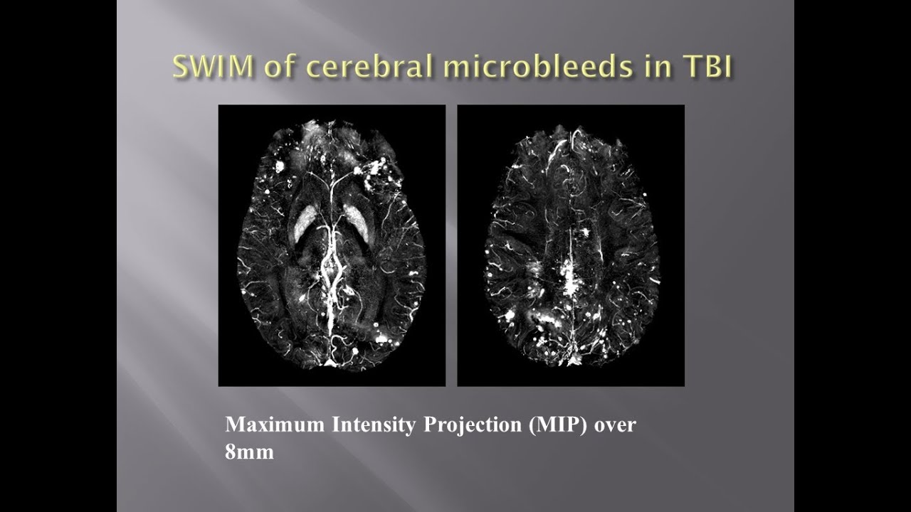 Imaging Traumatic Brain Injury