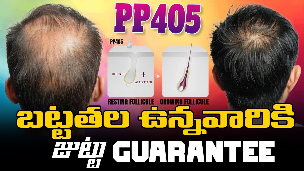 #AskDrJohnWatts | PP405 - బట్టతల ఉన్నవారికి జుట్టు GUARANTEE | Hair Specialist Explains