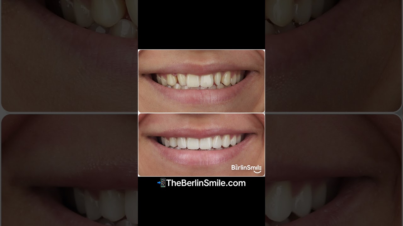 Two prepless veneers. Small change. Big difference. 😌 