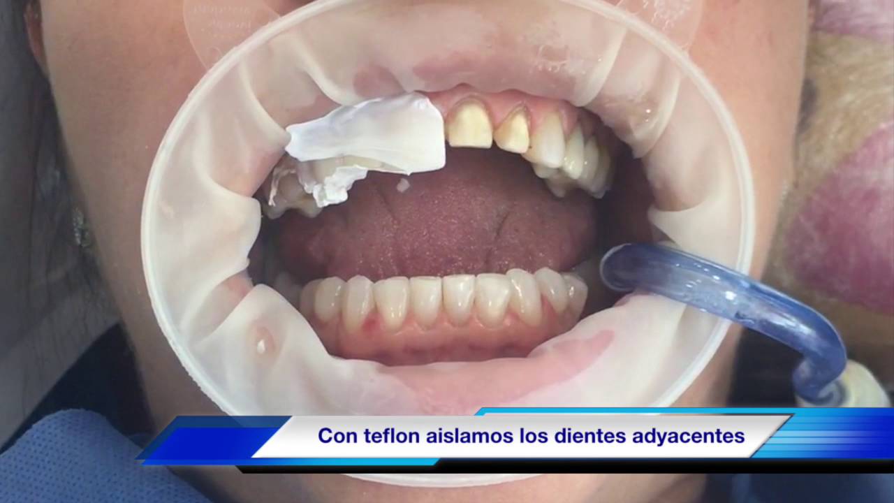Cementación de carillas