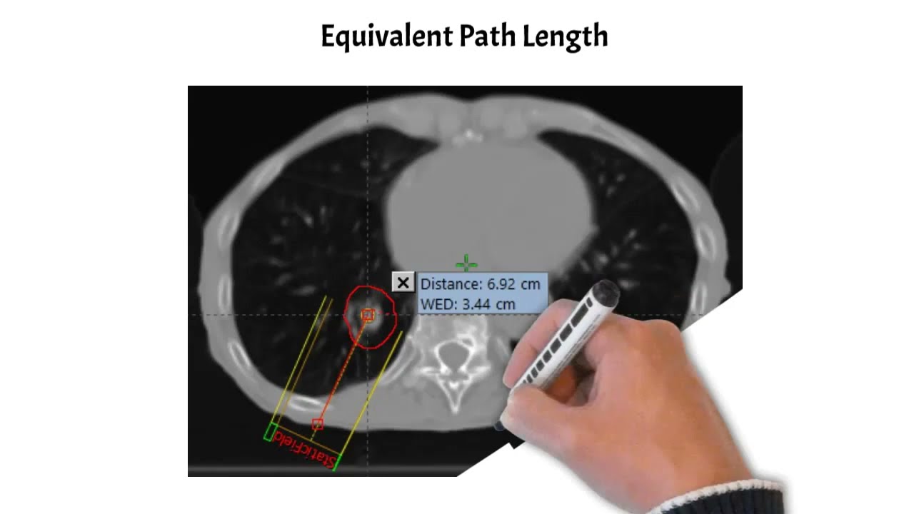 Radiotherapy Hand Calculations: Limitations