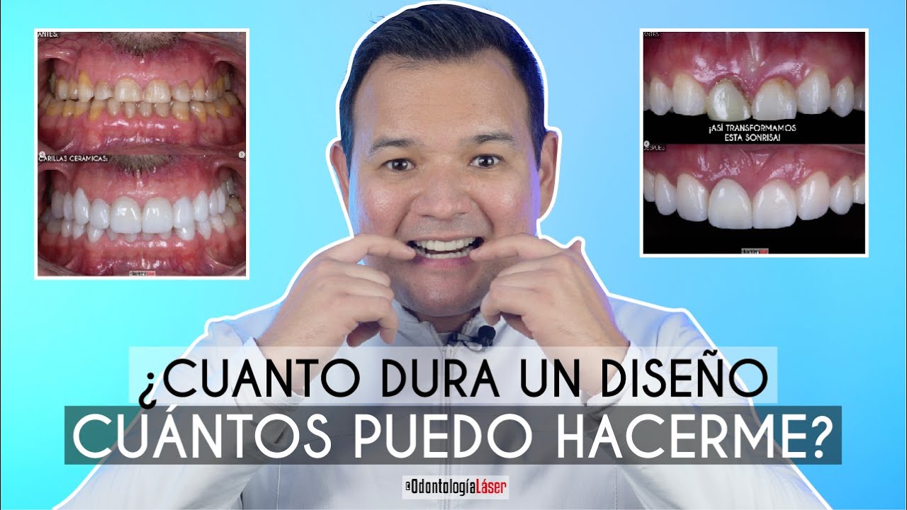 &iquest;Cu&aacute;nto Dura un Dise&ntilde;o de Sonrisa? &iquest;Cu&aacute;ntos dise&ntilde;os me puedo hacer? - Odontolog&iacute;a L&aacute;ser