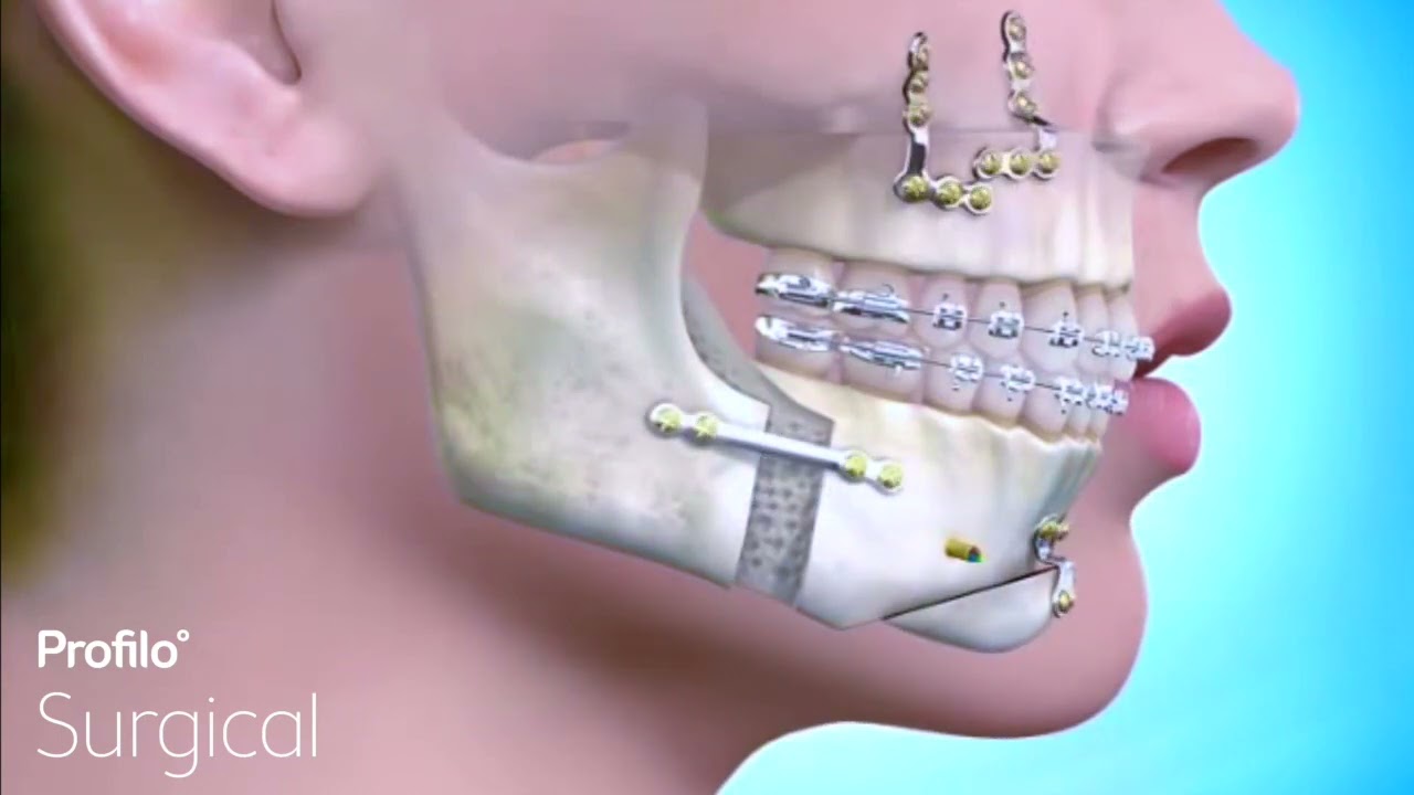Sleep Apnea Treatment - BiMax Surgical Advancement
