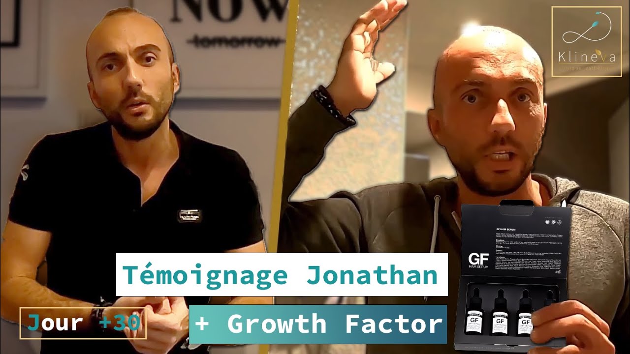 [Greffe Capillaire J+30] Mes Cheveux tombent ?! + Growth Factor