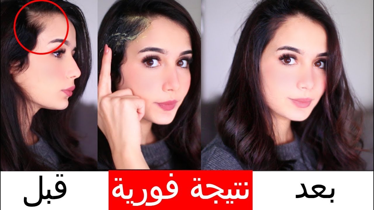 تكثيف الشعر المتساقط طبيعيا | قبل و بعد
