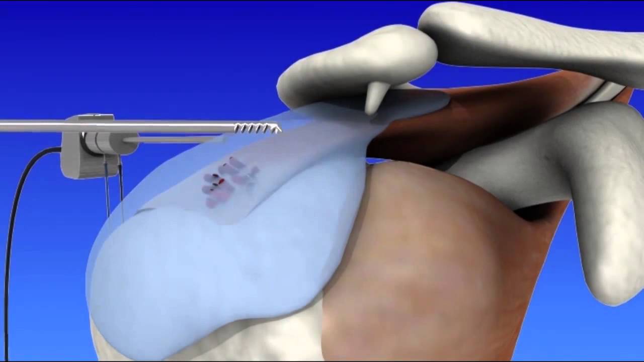 Shoulder Arthroscopy