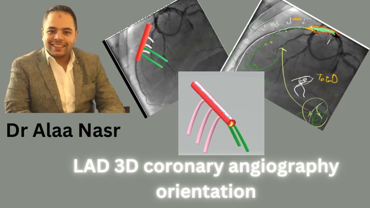 Coronary angiography LAD 3D orientation, Dr Alaa Nasr, 2023