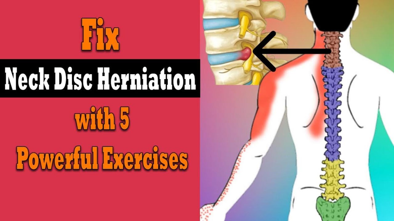 How Disc Herniation Happens & 5 Simple Exercises to Fix It!