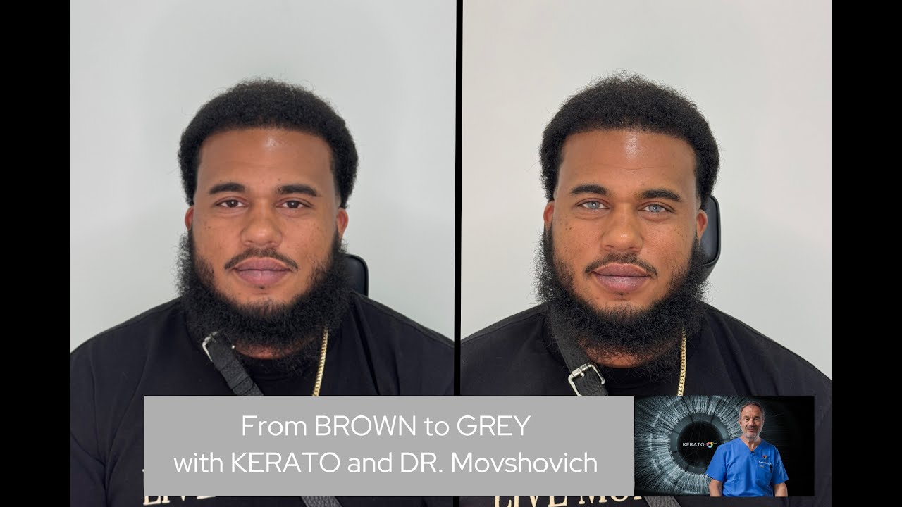 Safe eye color change at KERATO by Dr.Movshovich #KeratoNYC #keratoMIAMI #keratopigmentation #tattoo
