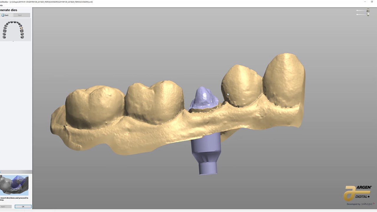 3Shape iTero case through model builder.