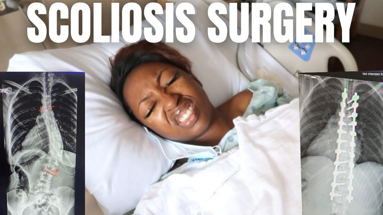 Scoliosis Surgery Vlog | Spinal Fusion 2021
