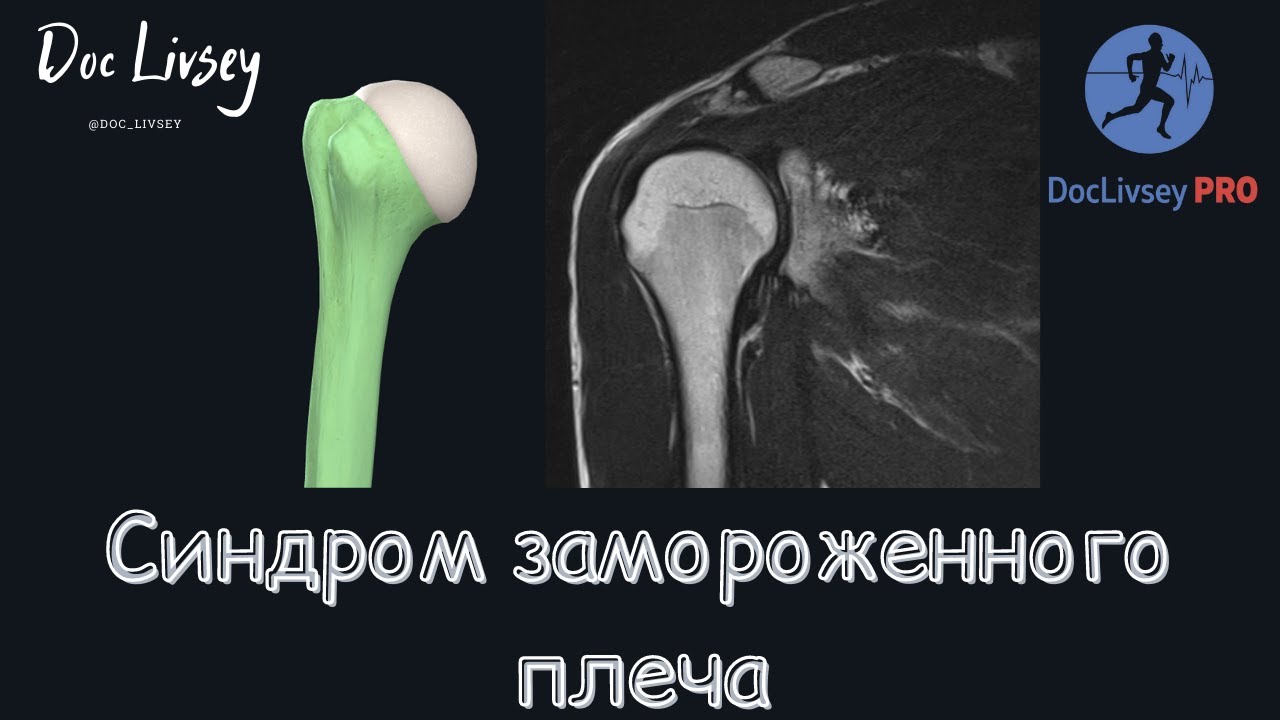 Синдром замороженного плеча