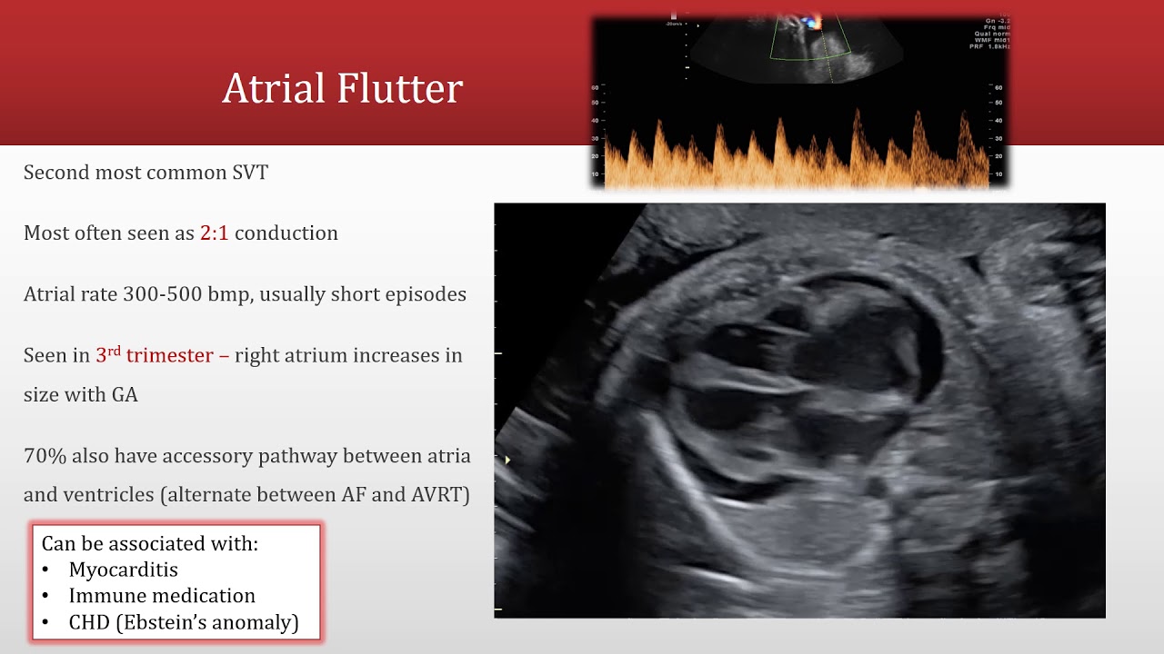 Fetal Arrhythmias Part 2: Assessing Tachyarrhythmia and Bradyarrhythmia