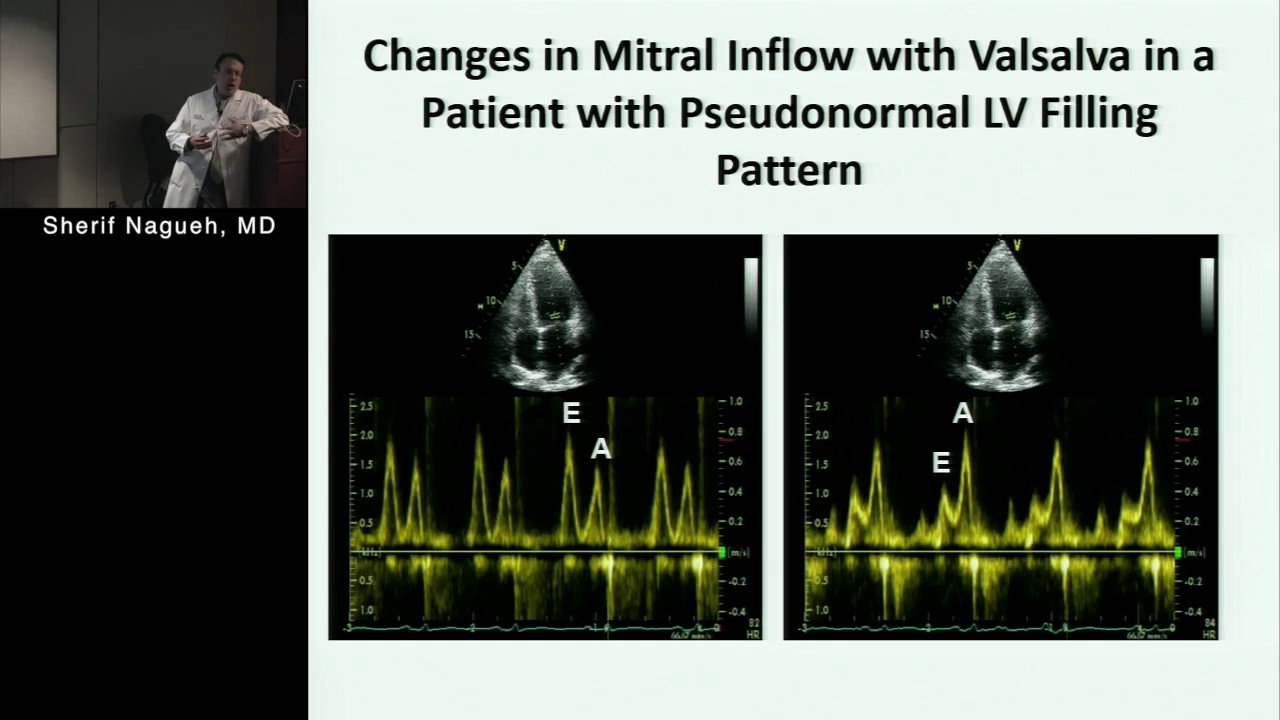 Multicenter Study of Echocardiographic Assessment of LV Filling Pressures