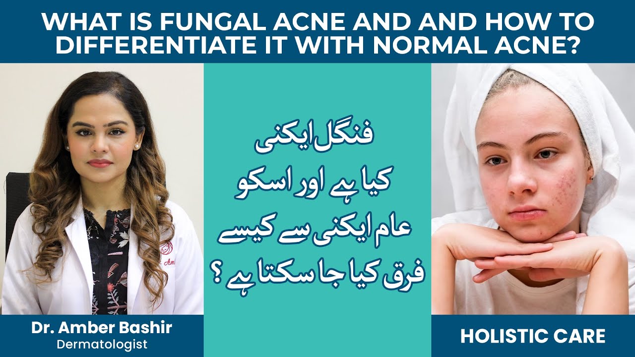 Do you know what Fungal Acne is? | Kya app bhi is cheez se tang hain? | Dr. Amber Bashir | Treatment