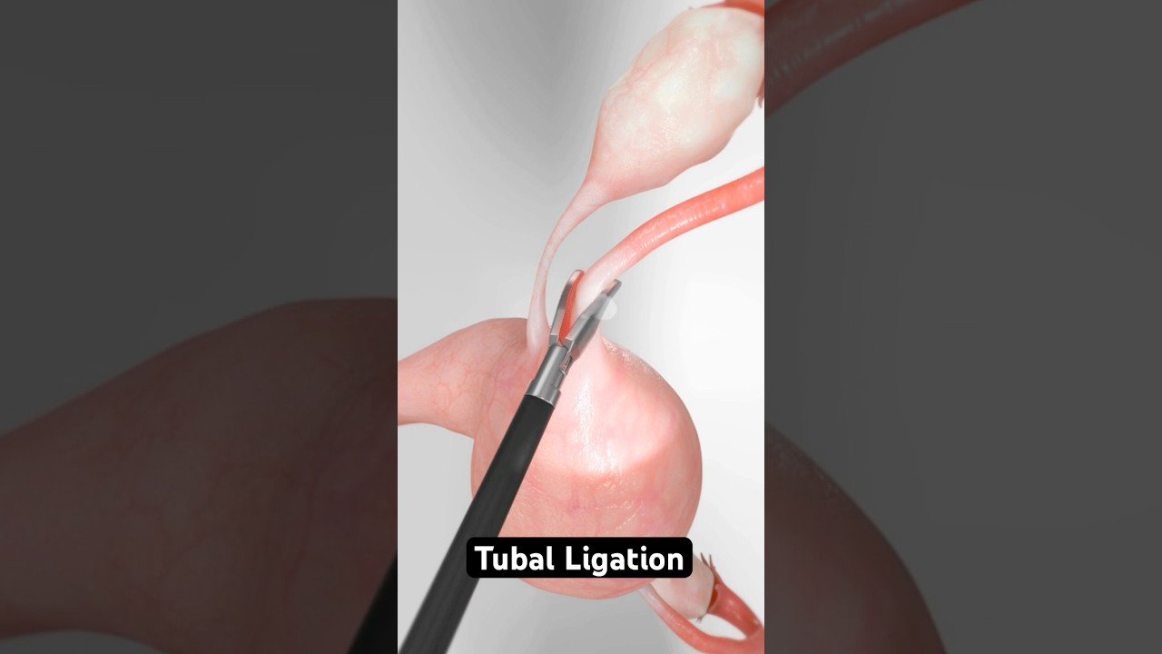 Three methods for permanent female sterilization (3D Animation)