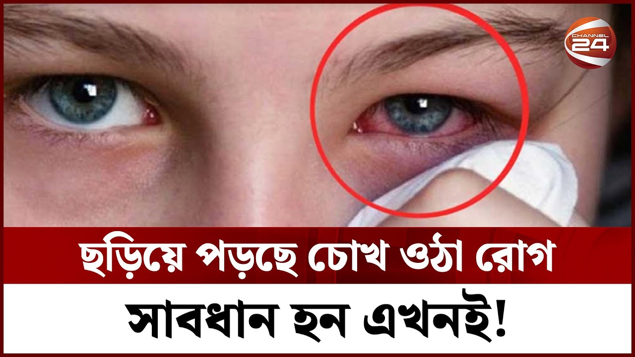 চোখ ওঠা রোগ হলে করণীয় কি? Health Tips || Channel 24