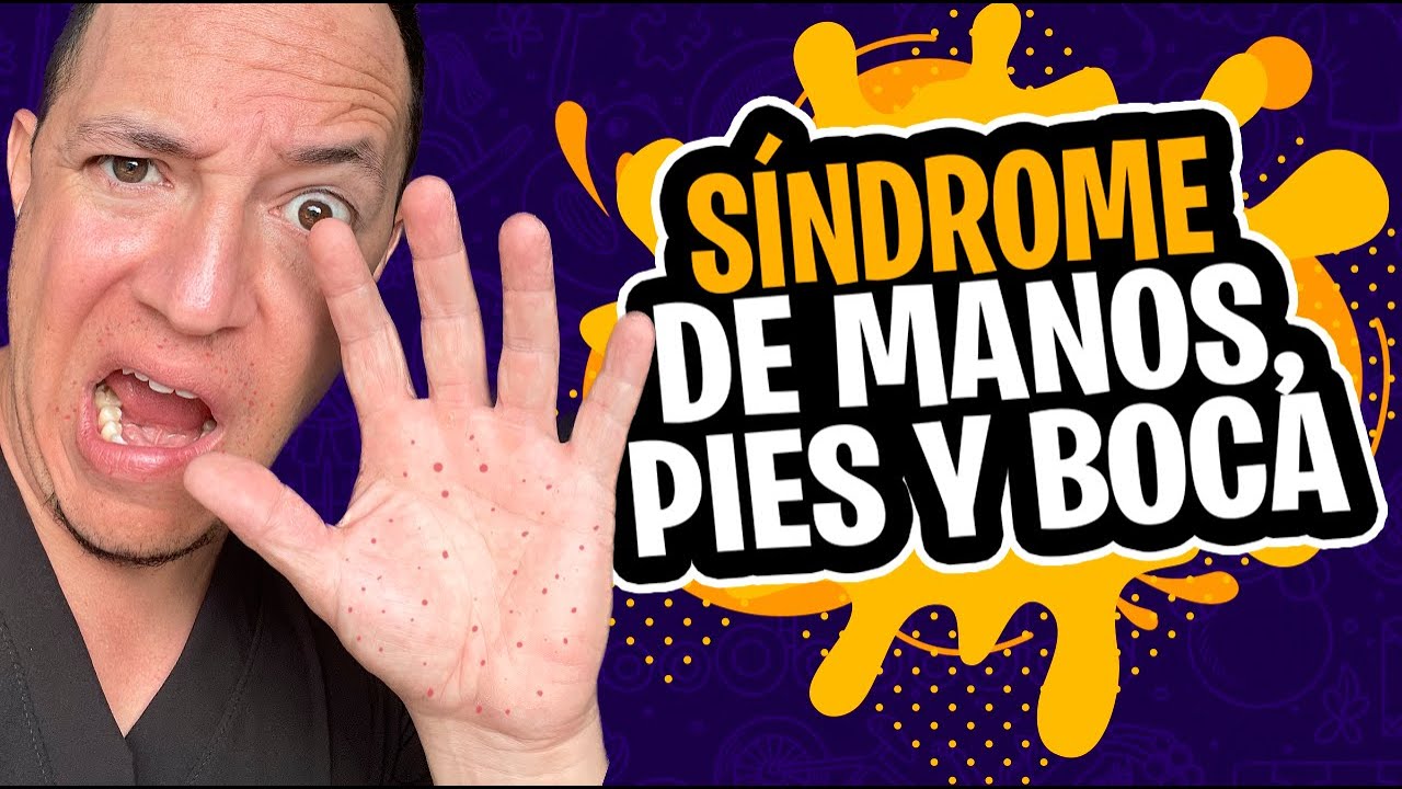 Todo sobre el S&iacute;ndrome de pies, manos y boca