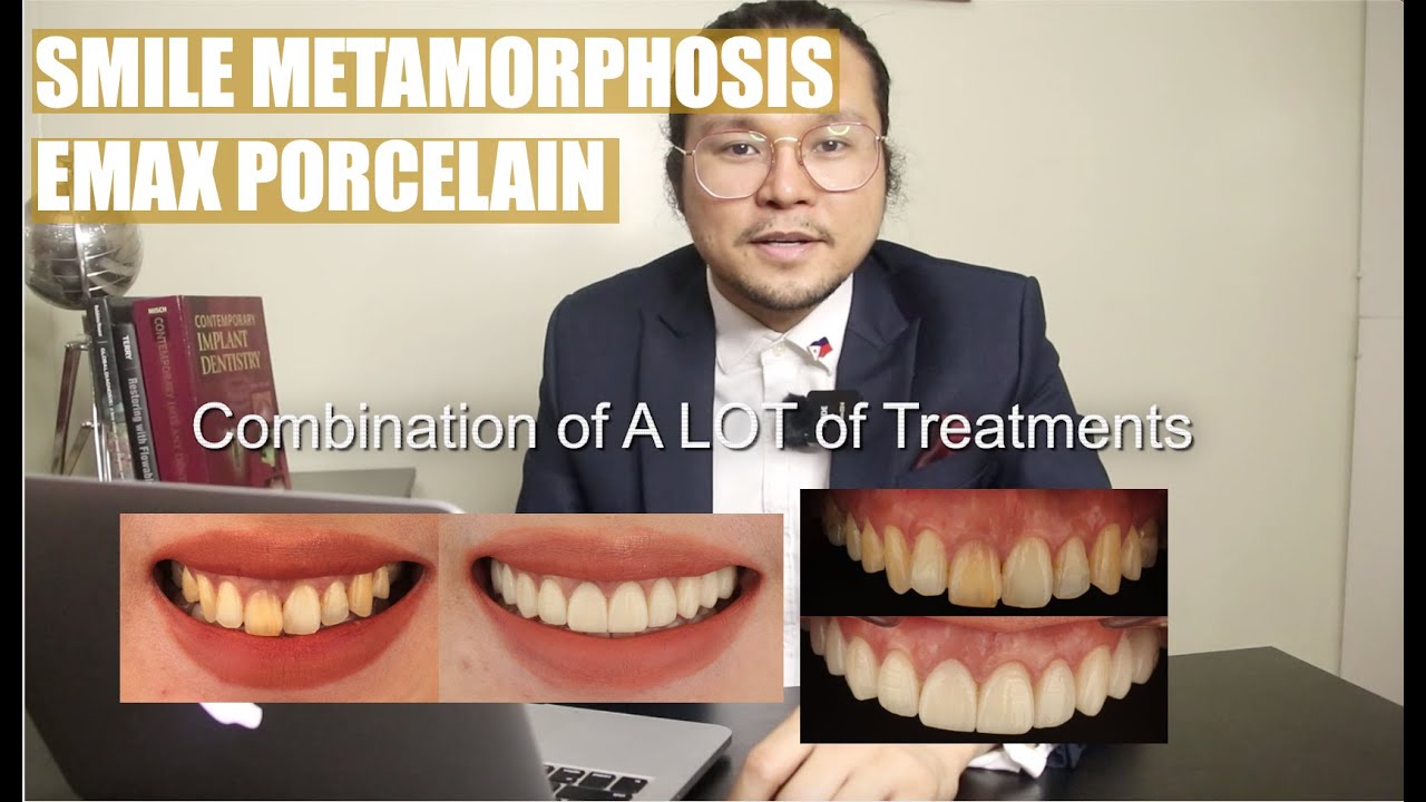 Smile Metamorphosis | Veneers | Apostol Dental