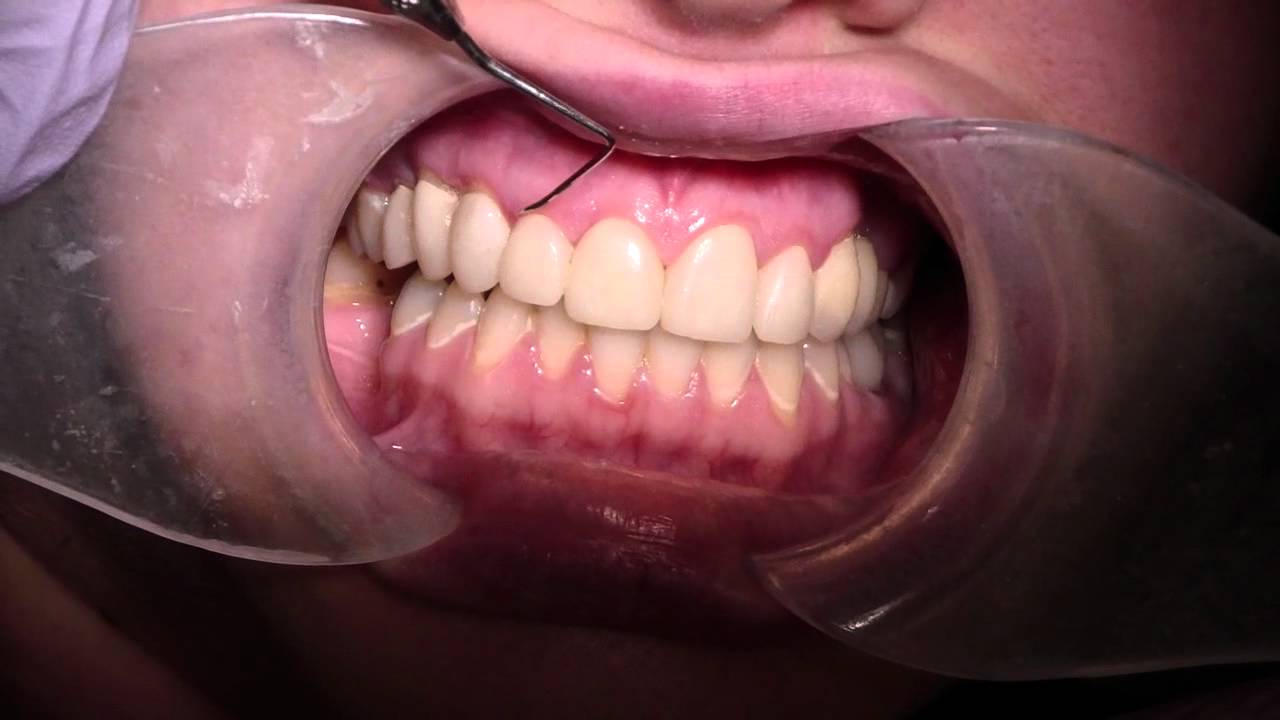 Dental Papilla - Will it return? (Tarnow et al. 1992)