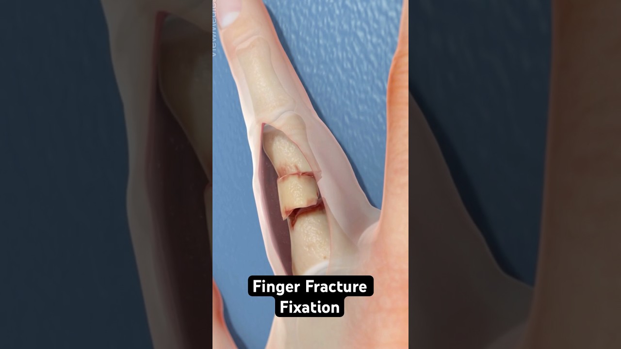 Fixing a fractured finger (3D Animation)