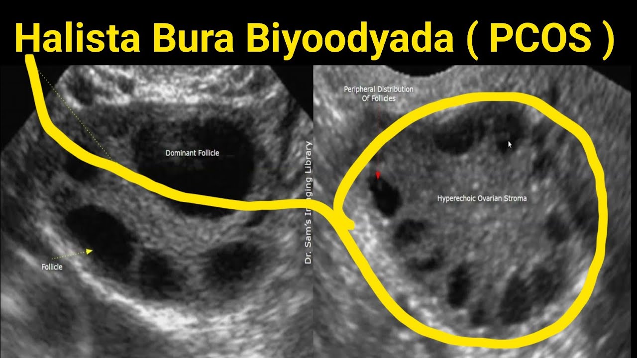 Qalqalka Hormoonada Dumarka iyo Burada (  PCOS ) calaamadaha iyo xalka
