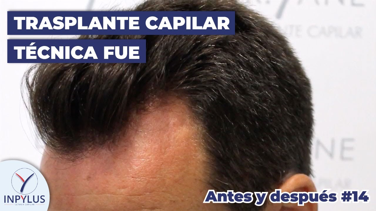 Trasplante capilar técnica FUE - Clínica Inpylus