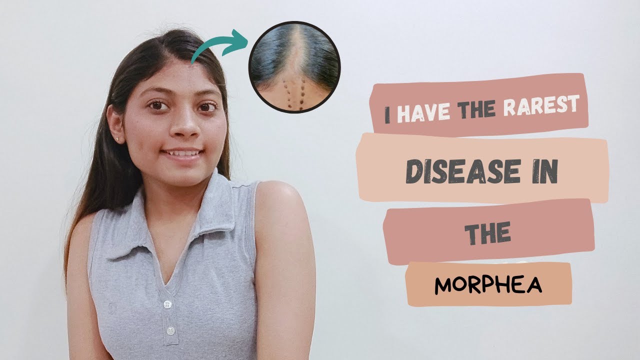 I HAVE RAREST DISEASE IN THE WORLD MORPHEA || EPISODE 3 || Simran Nik