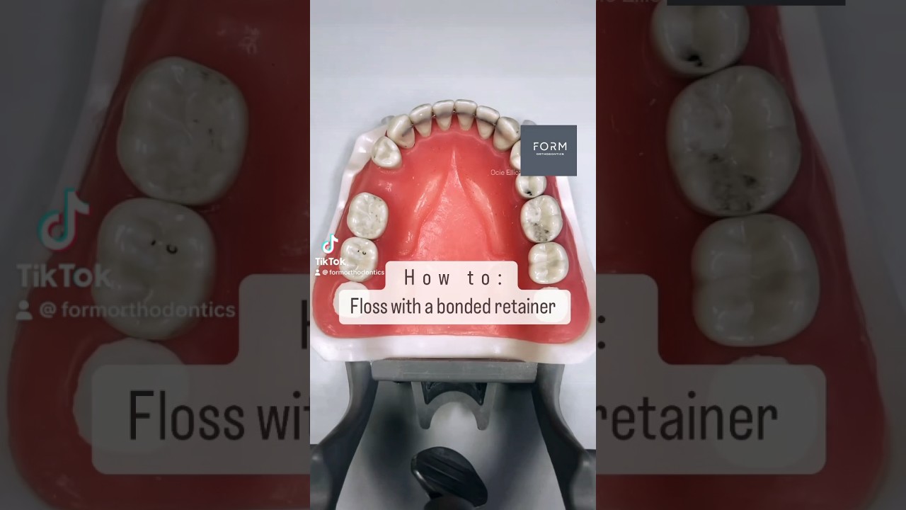 How to floss your lower bonded retainer!!! #retainers #orthodontist #braces #invisalign