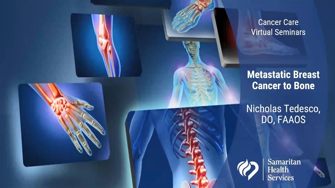 Metastatic Breast Cancer to Bone  - A Cancer Care Seminars