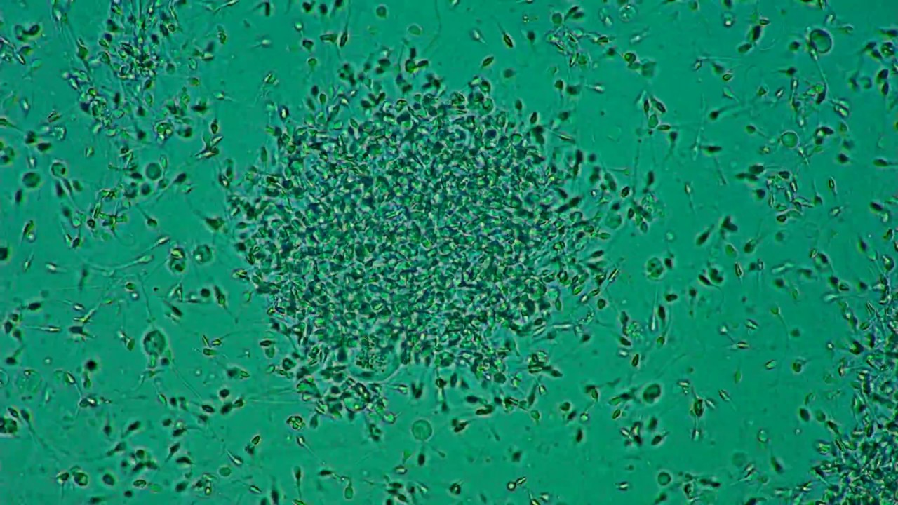 Andrologia. Sperma hominis. Glutinatio. (Andrology. Human sperm. Agglutination.)