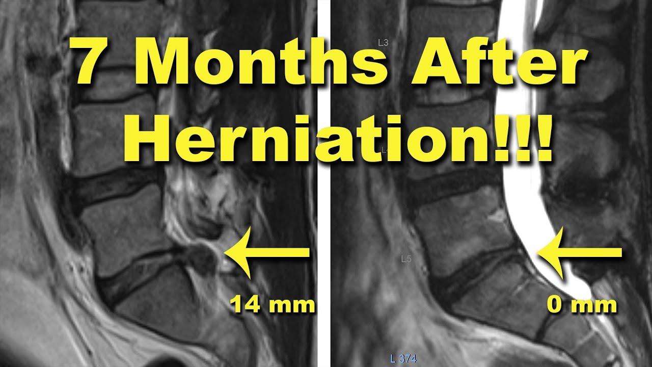 Stem Cells Heal Massive Herniated Disc in 7 Months!!  Sharing my 10 year MRI history