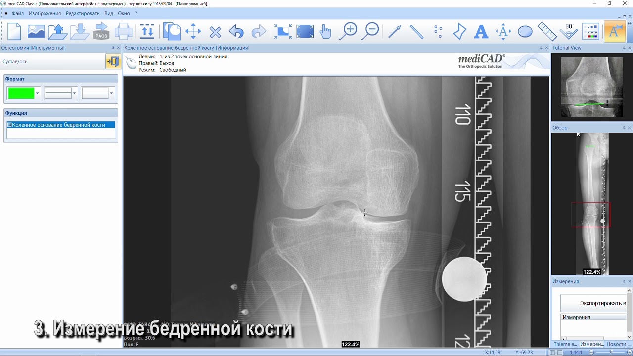 Osteotomie with mediCAD - предоперационное планирование