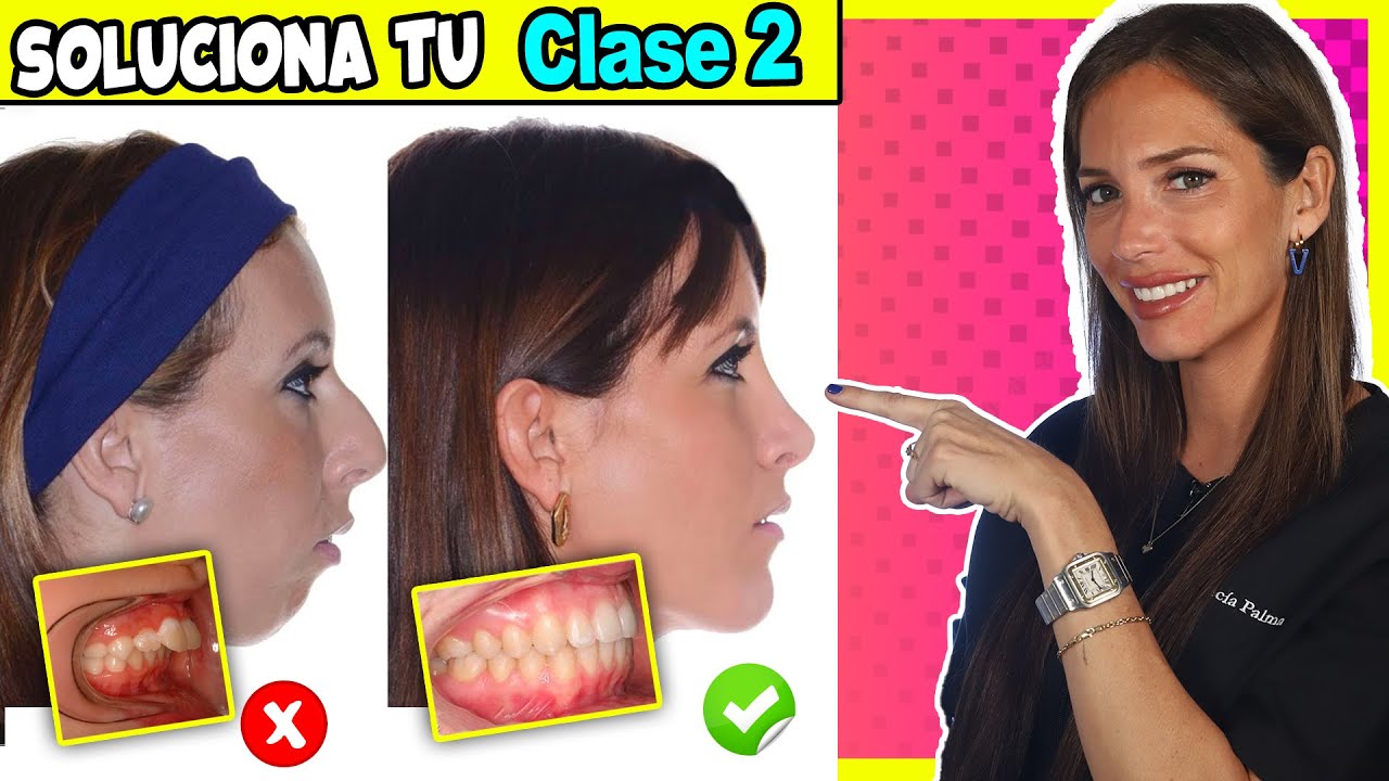 BRACKETS para 𝗗𝗜𝗘𝗡𝗧𝗘𝗦 𝗦𝗨𝗣𝗘𝗥𝗜𝗢𝗥𝗘𝗦 𝗔𝗗𝗘𝗟𝗔𝗡𝗧𝗔𝗗𝗢𝗦 ✅ 𝗖𝗟𝗔𝗦𝗘 𝟮 Ortodoncia TRATAMIENTO (SI, TIENE SOLUCIÓN👌)