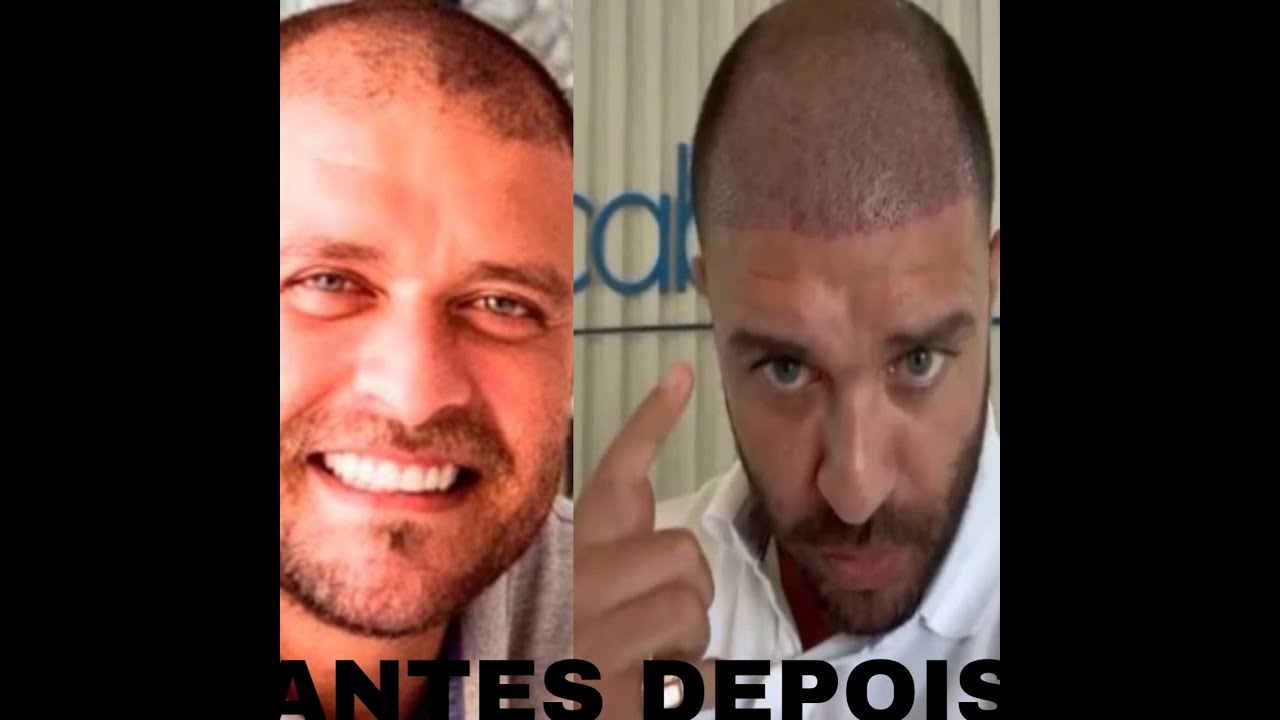 Diogo Nogueira Transplante Capilar - Antes e Depois