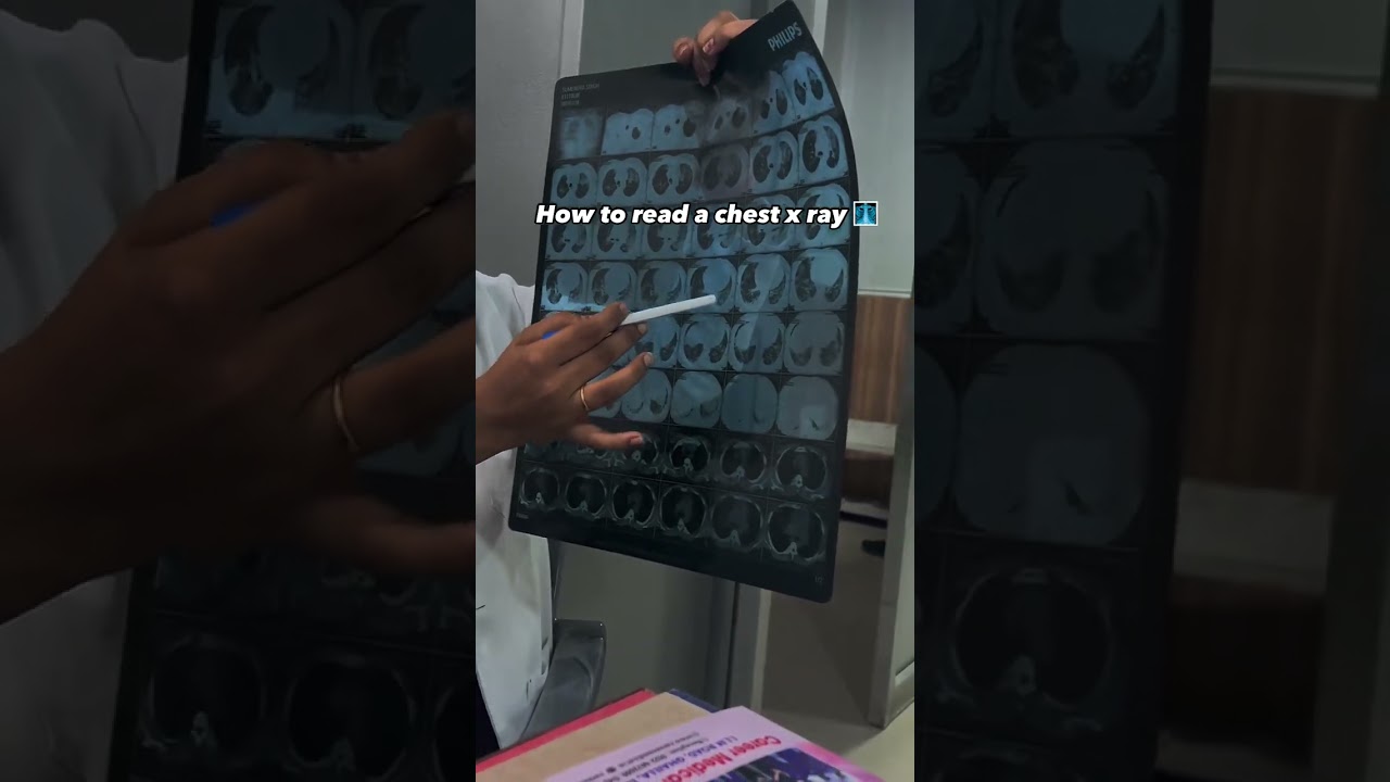 how to read chest xray
