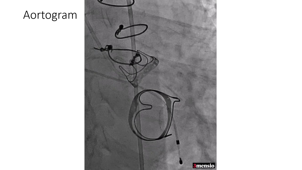 Transcatheter Double Valve Replacement (TAVR + Valve # ----  staged Tip-to-Base LAMPOON + TMVR)
