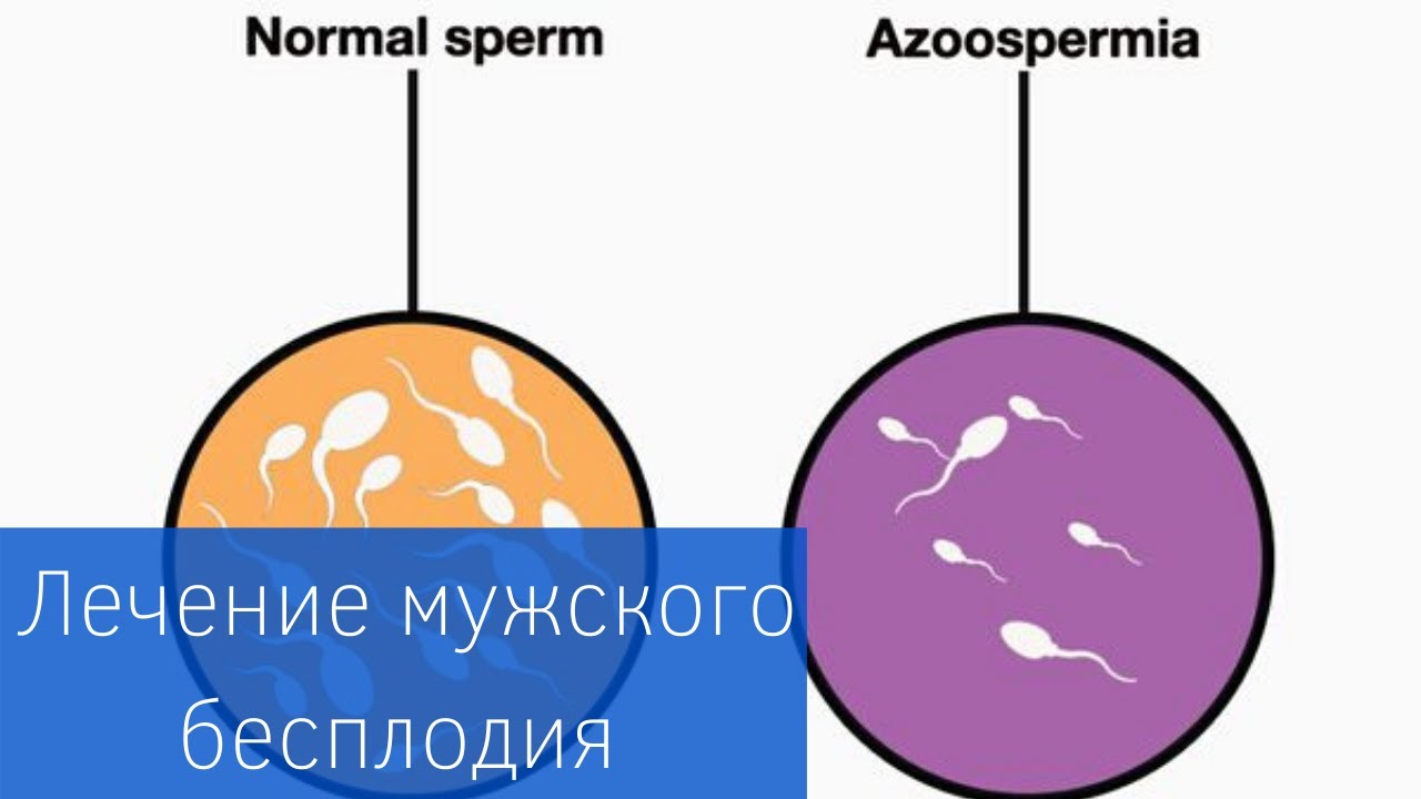 МУЖСКОЕ БЕСПЛОДИЕ | Азооспермия: диагностика и лечение