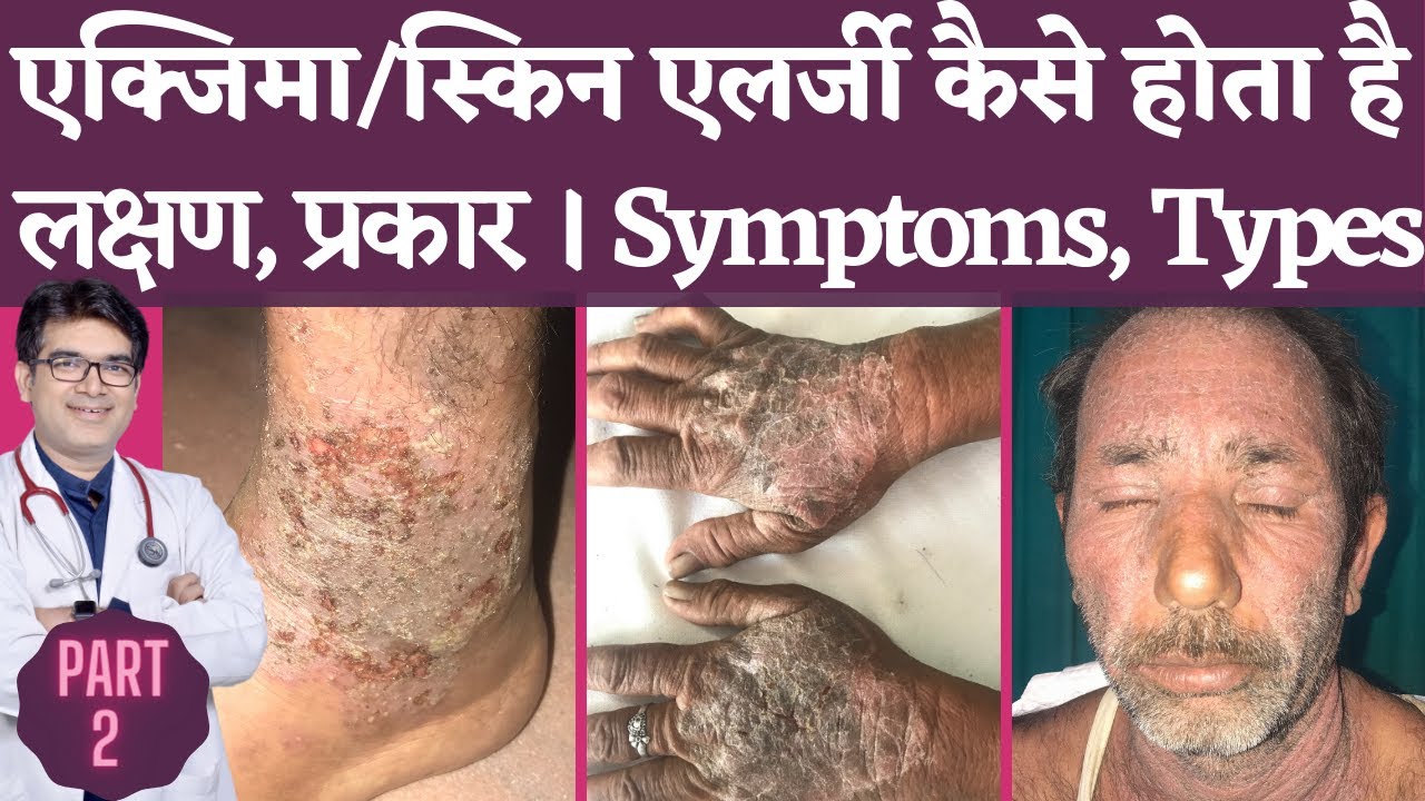 एक्ज़ेमा Symptoms In Hindi | Eczema Types with Pictures | लक्षण और प्रकार | Dermatologist | Jaipur